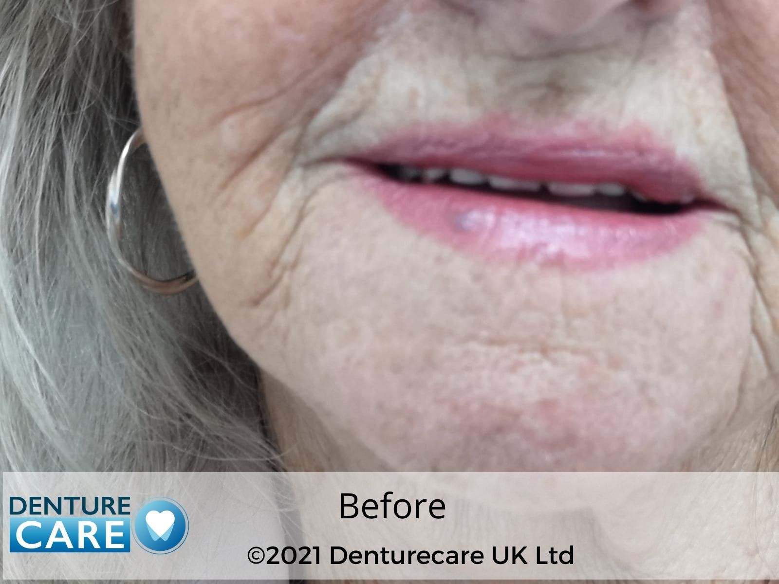 Dentures before and after photos