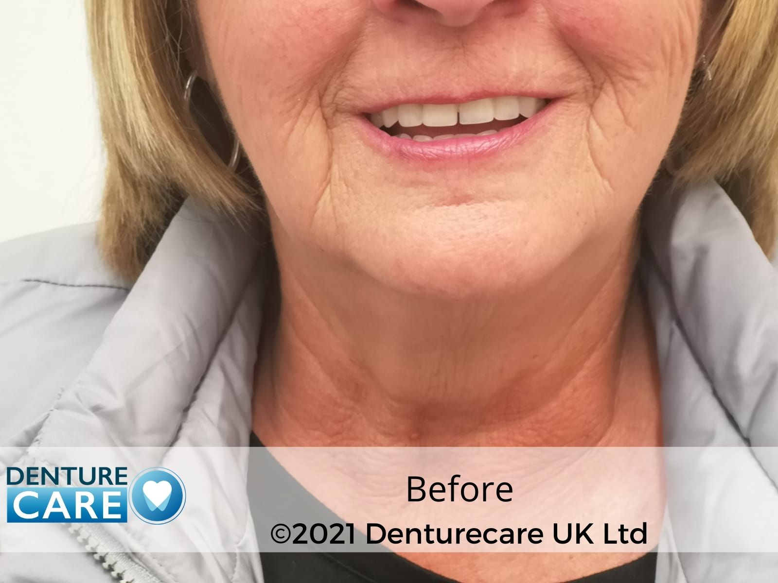 Dentures before and after photos