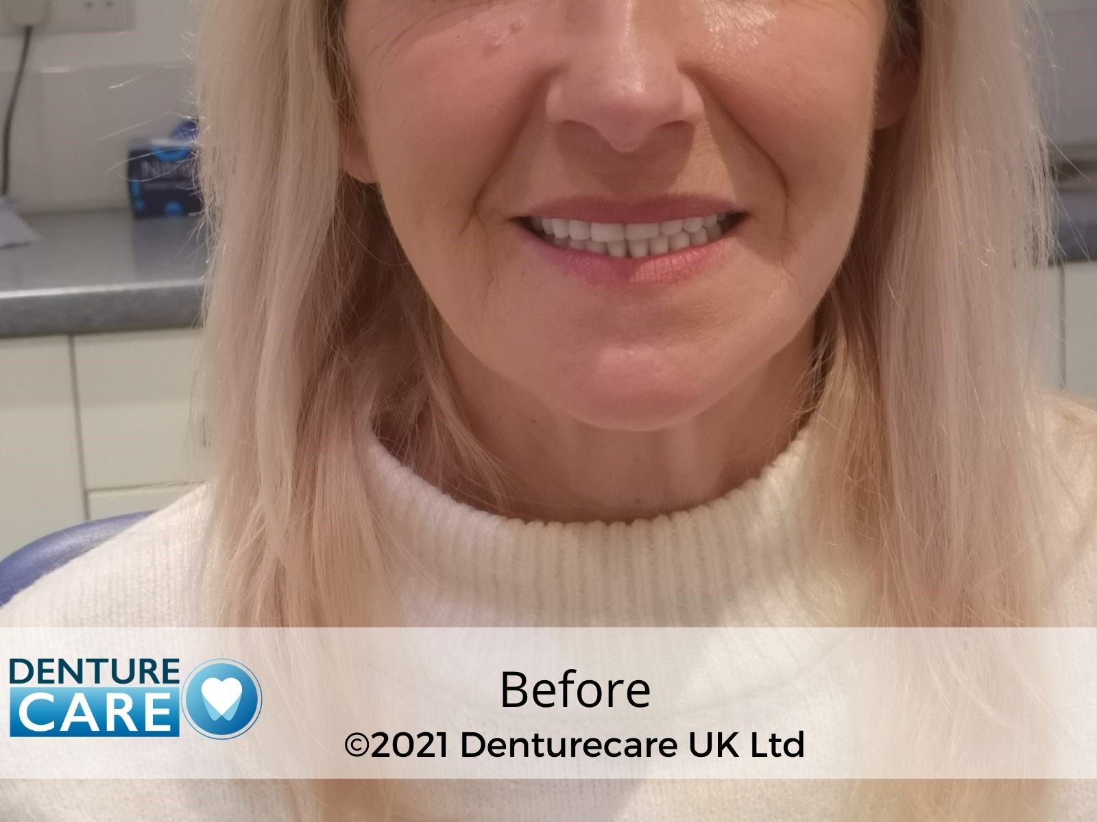 Dentures Before and After photos