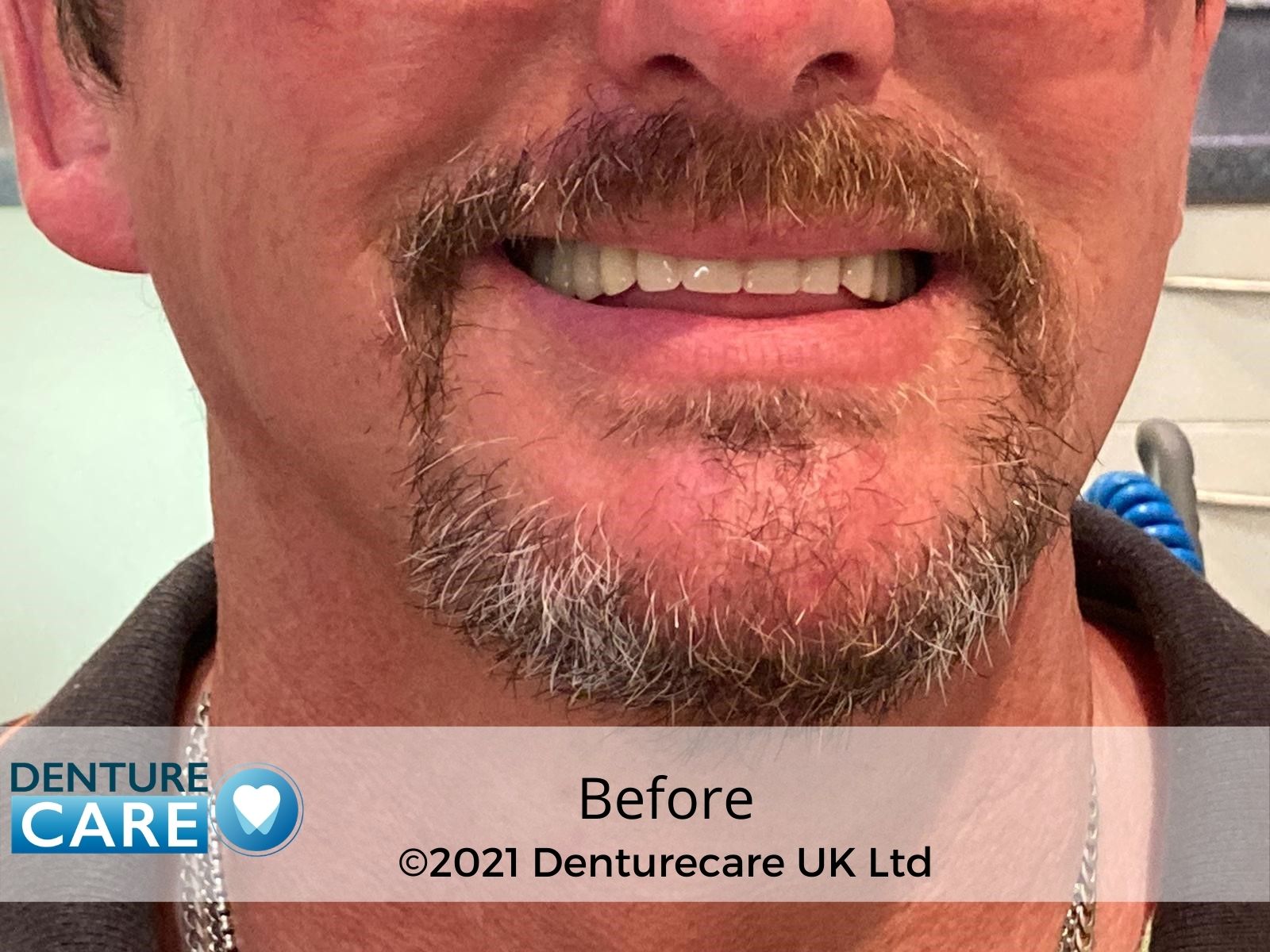 Before and after dentures photo