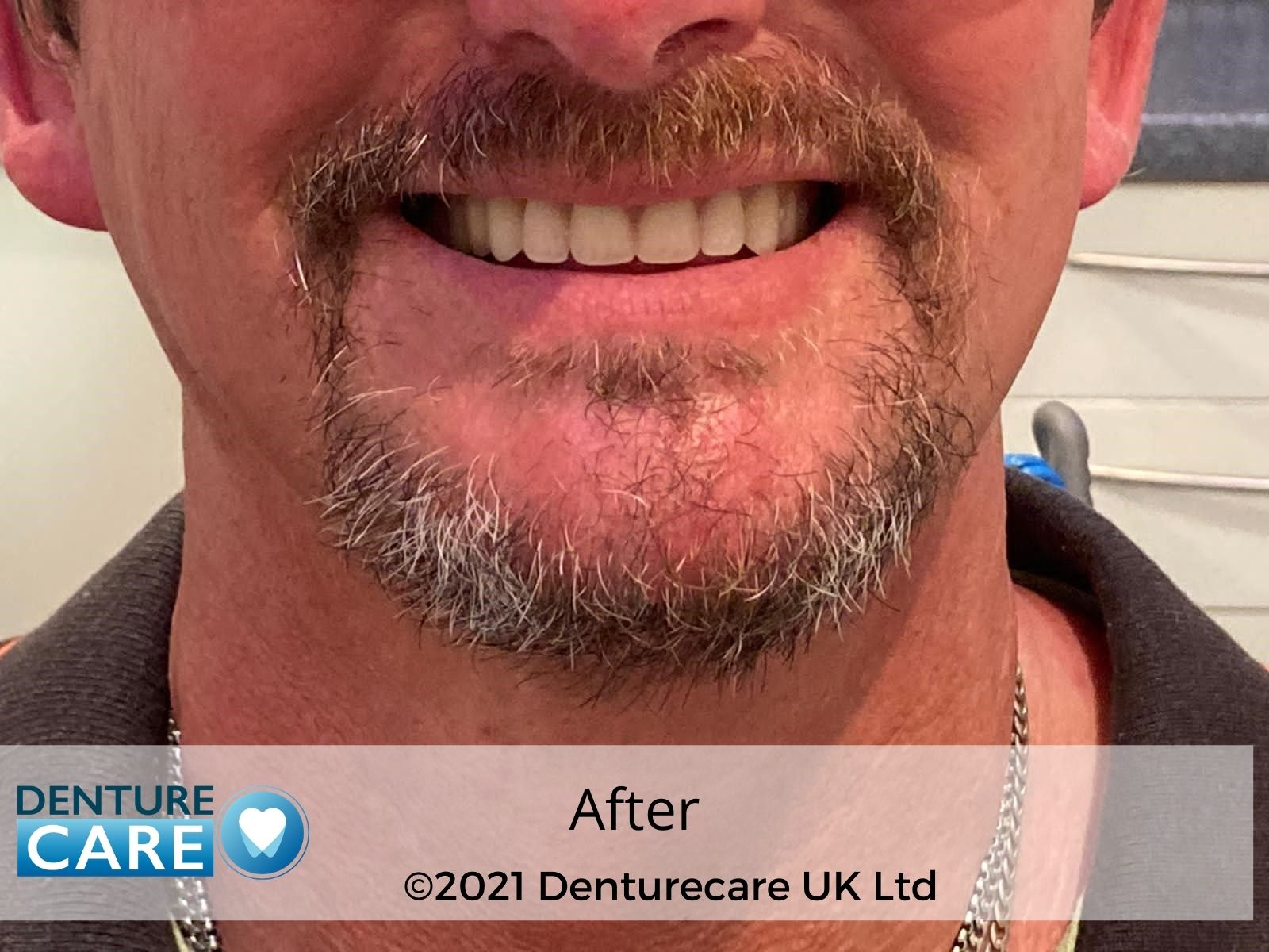 before and after dentures photo