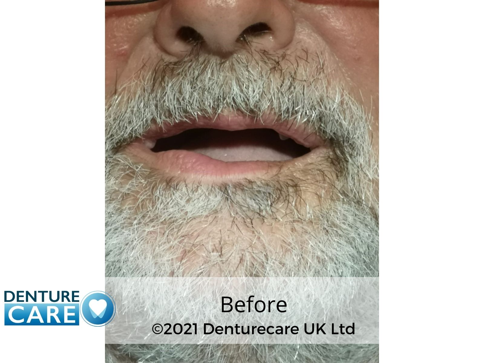 Before dentures