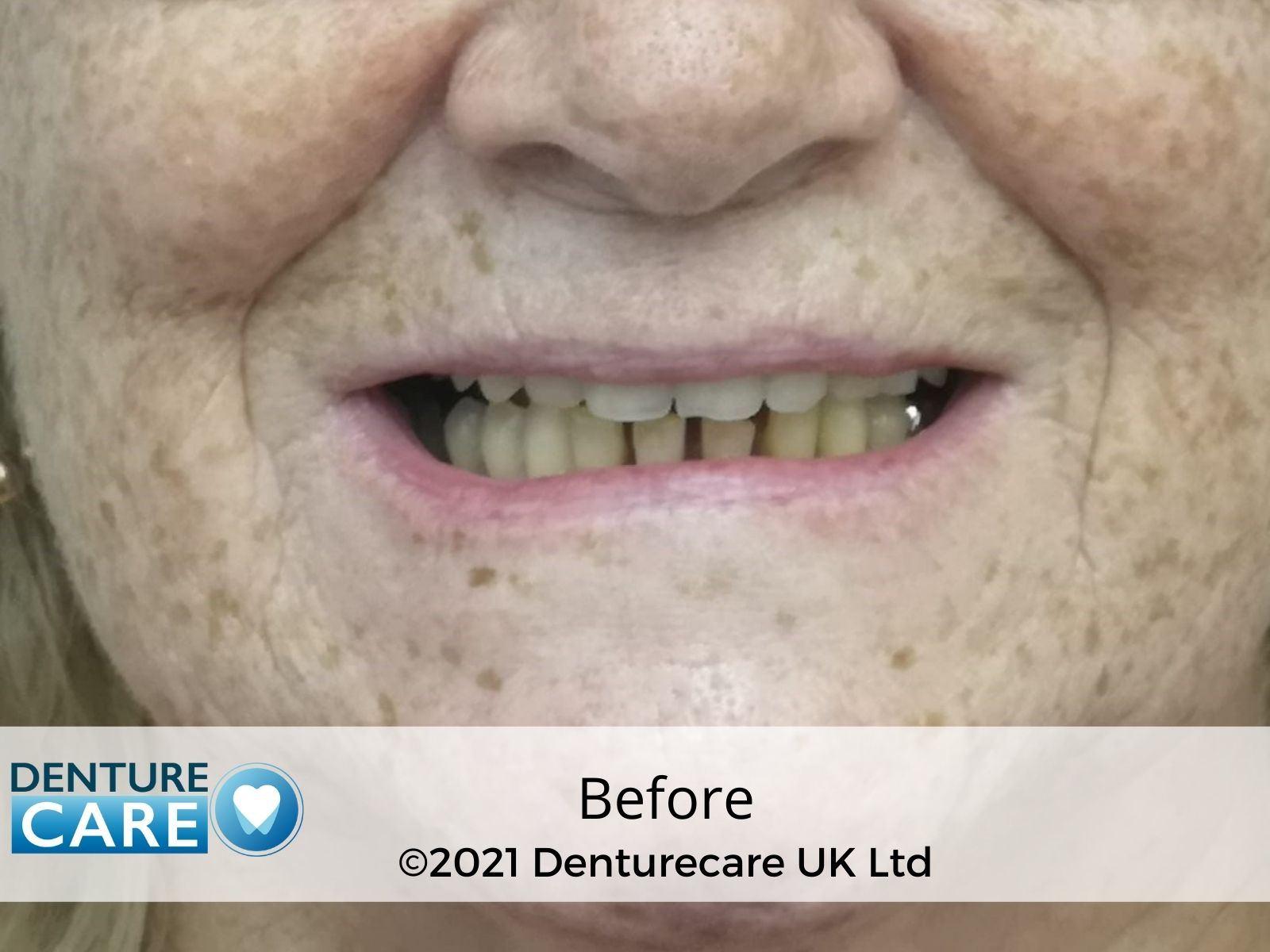 Before and after dentures photo