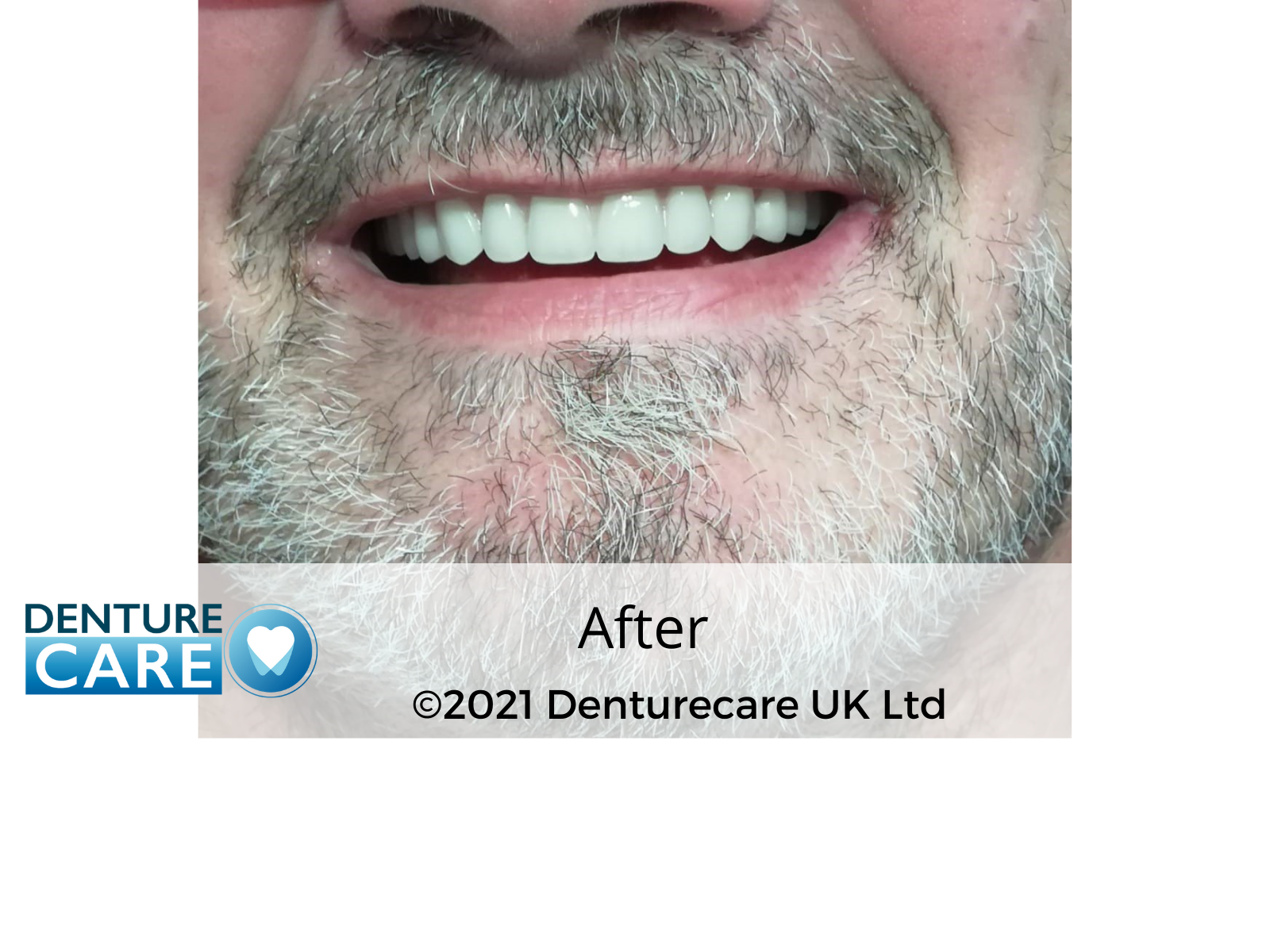 After new dentures