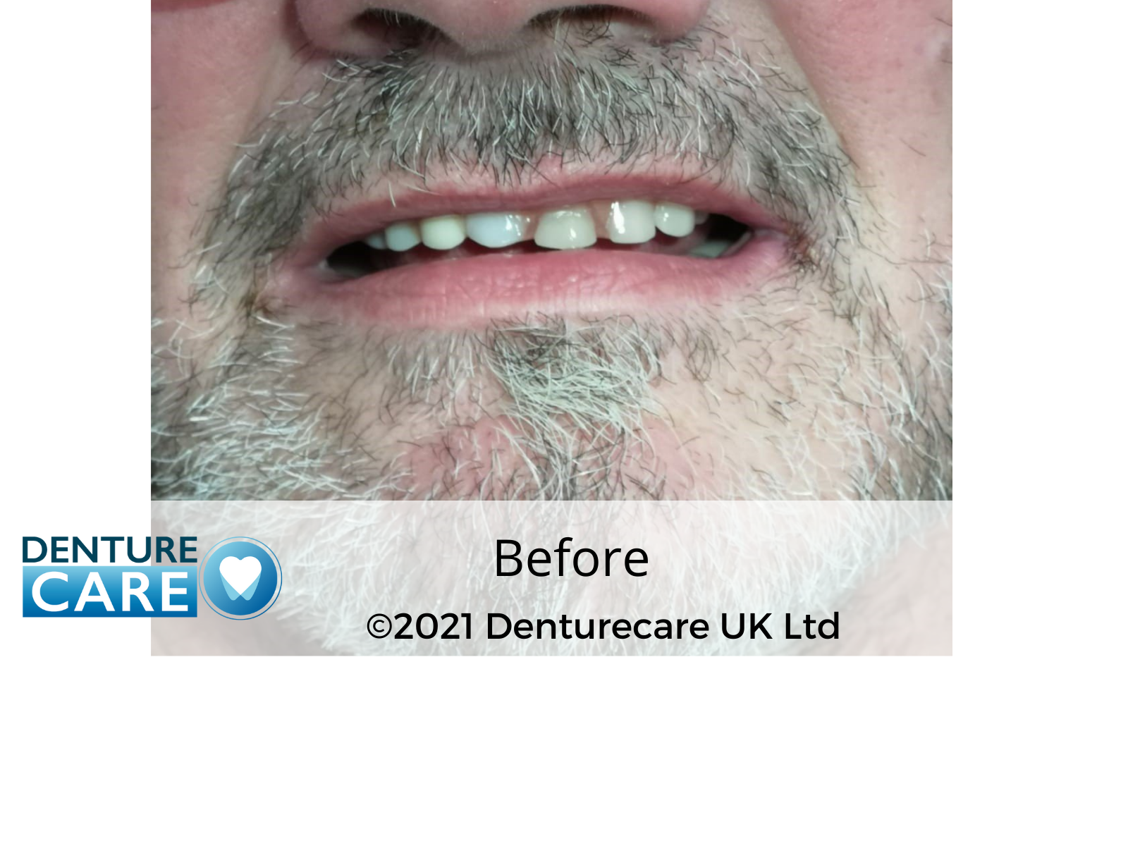 Before new dentures