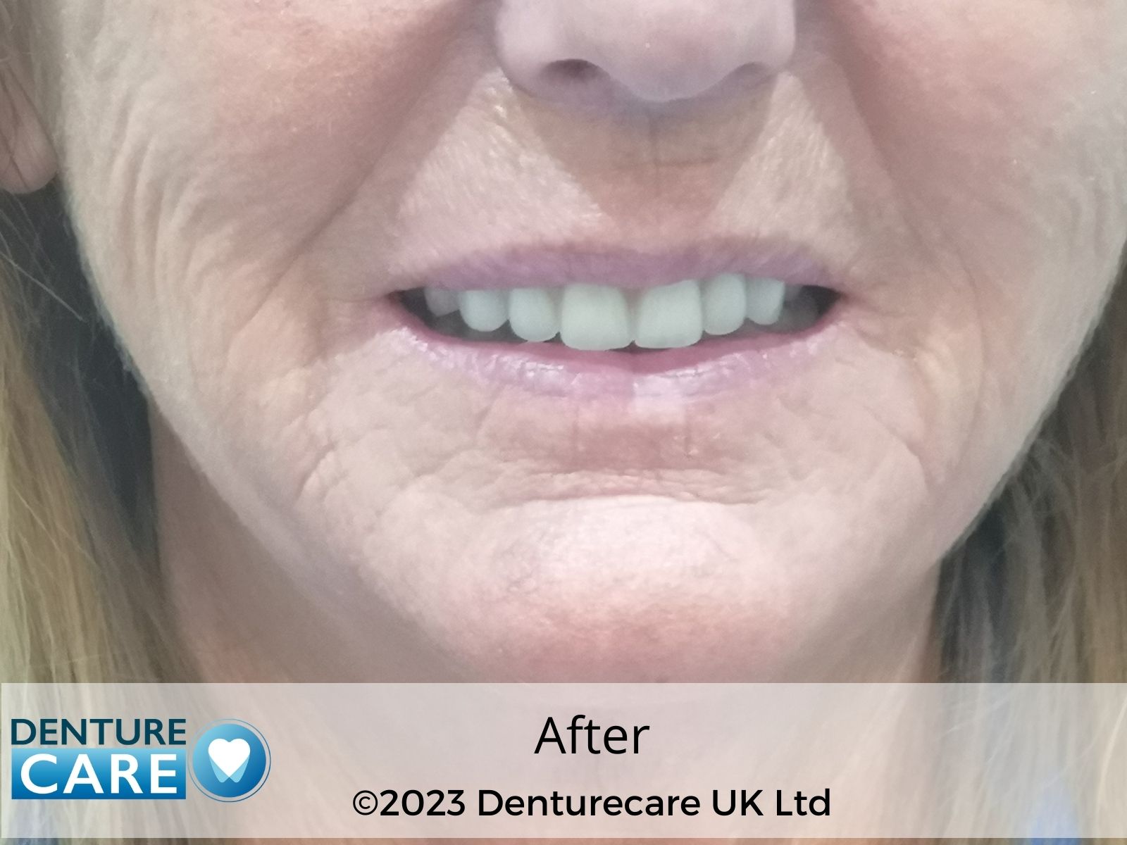 Before and after dentures photos