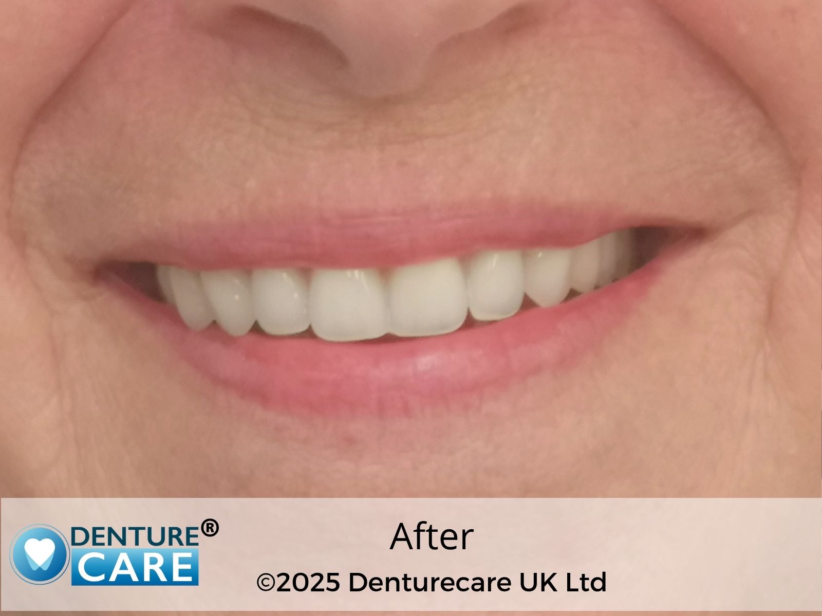 Patient’s smile after full upper dentures – Barnsley clinic