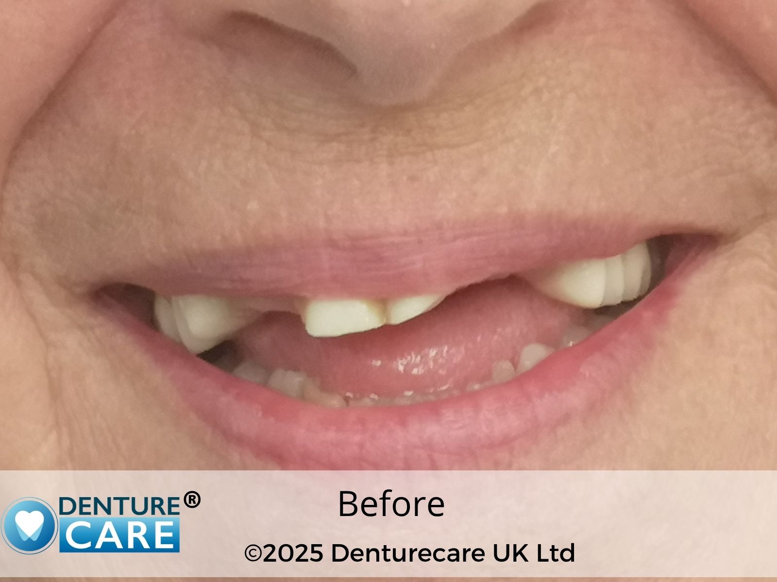 Patient’s smile before full upper dentures – Barnsley clinic