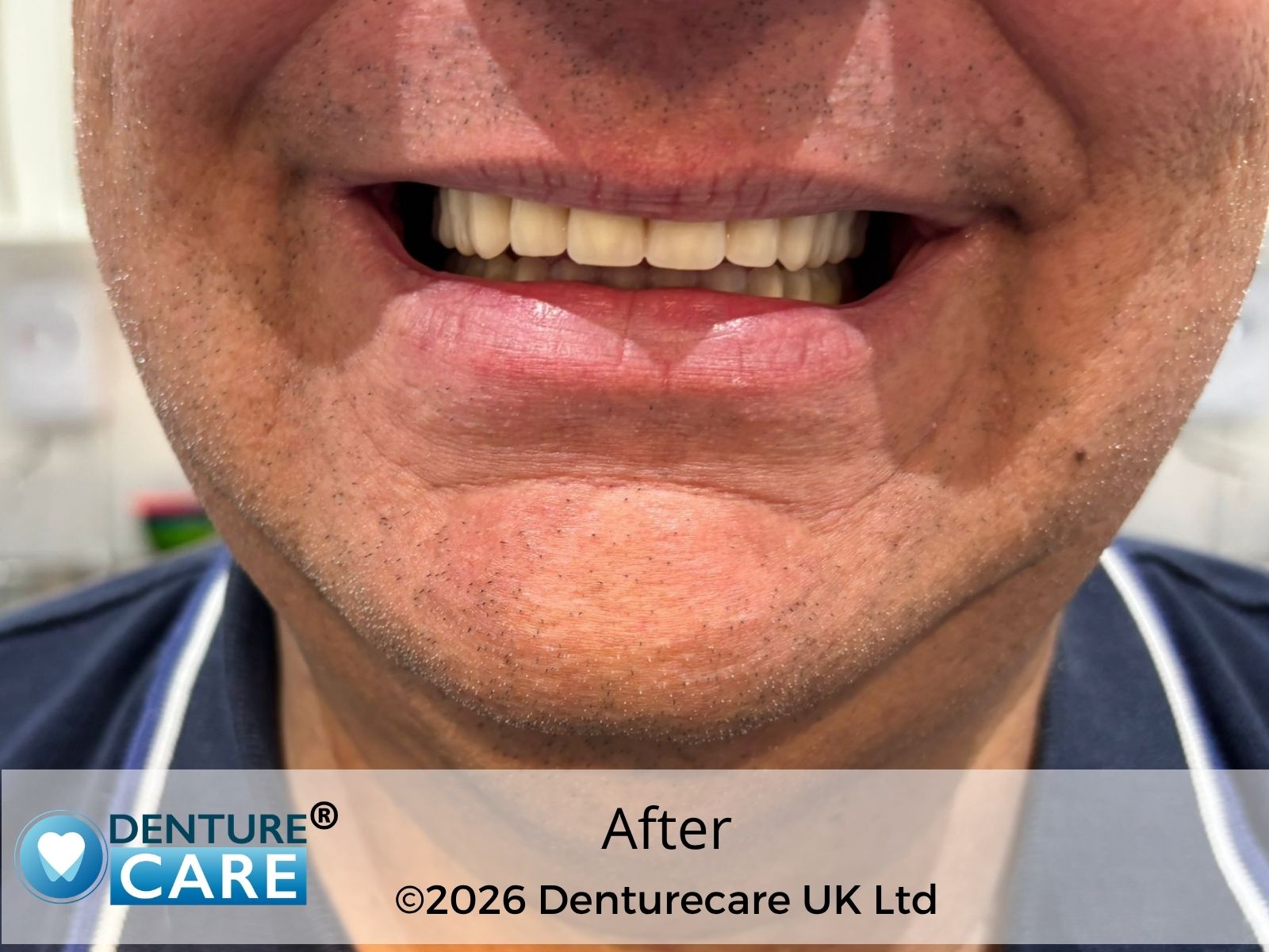 Patient’s smile after full dentures – Doncaster denture clinic