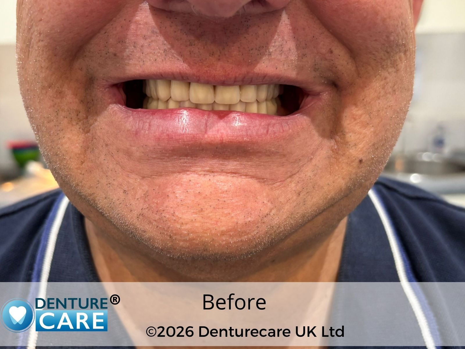 Patient’s smile before new full dentures – Doncaster denture clinic