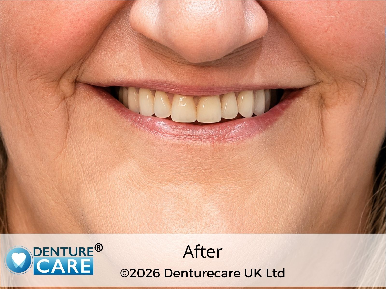 Patient’s smile after full upper dentures – doncaster Denture clinic
