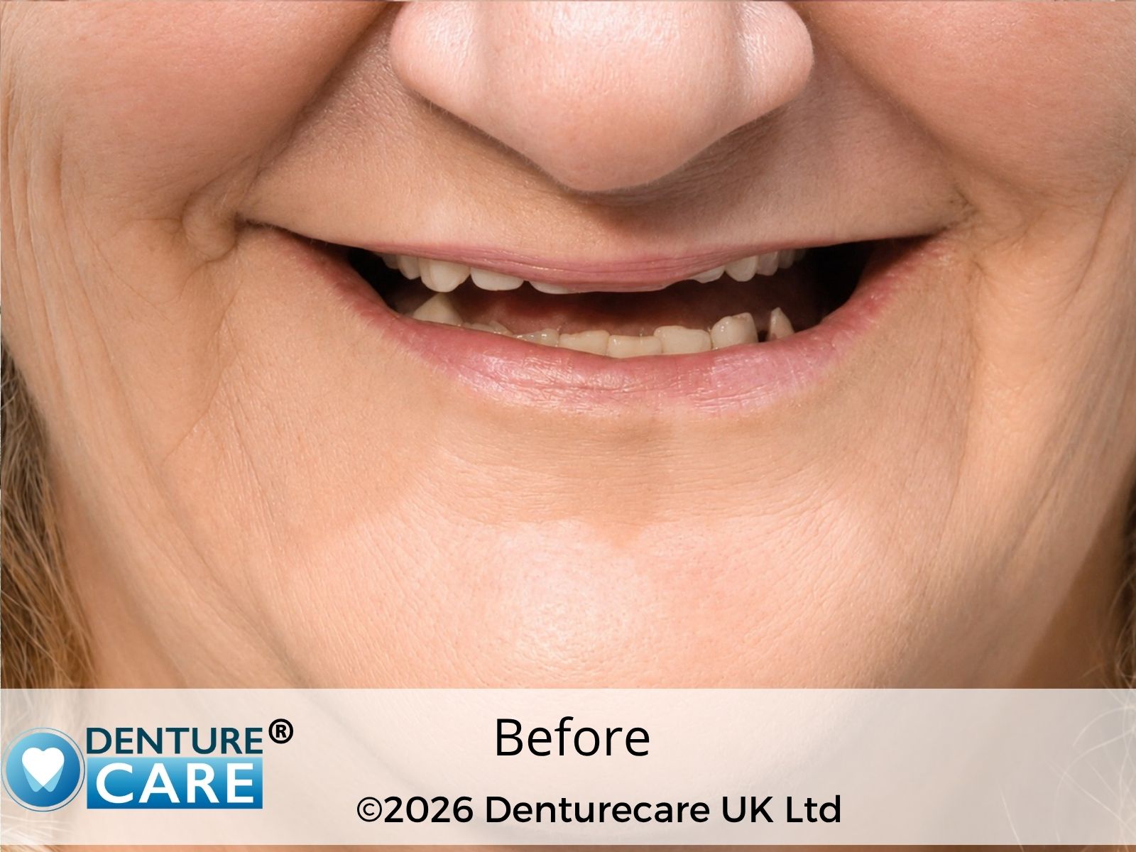 Patient’s smile before new full dentures – Doncaster denture clinic