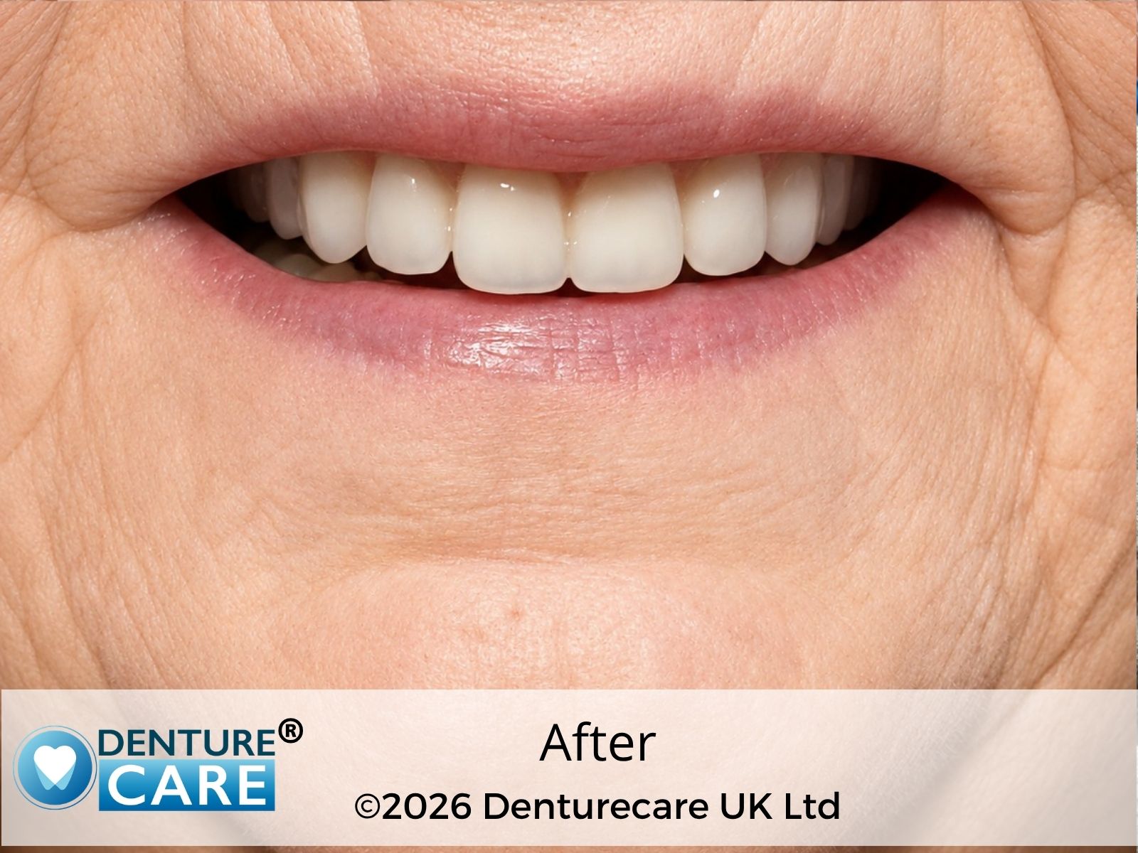 Patient’s smile after full upper dentures – doncaster Denture clinic