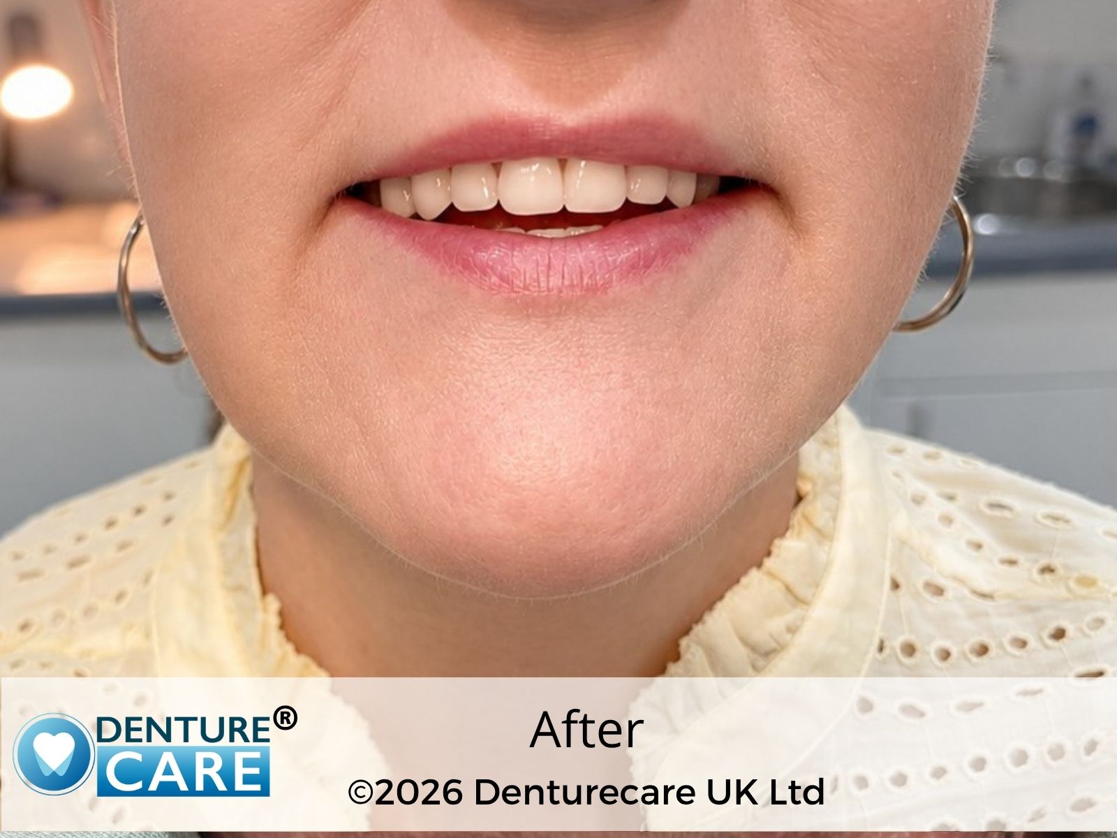 Patient’s smile after full upper dentures – doncaster Denture clinic