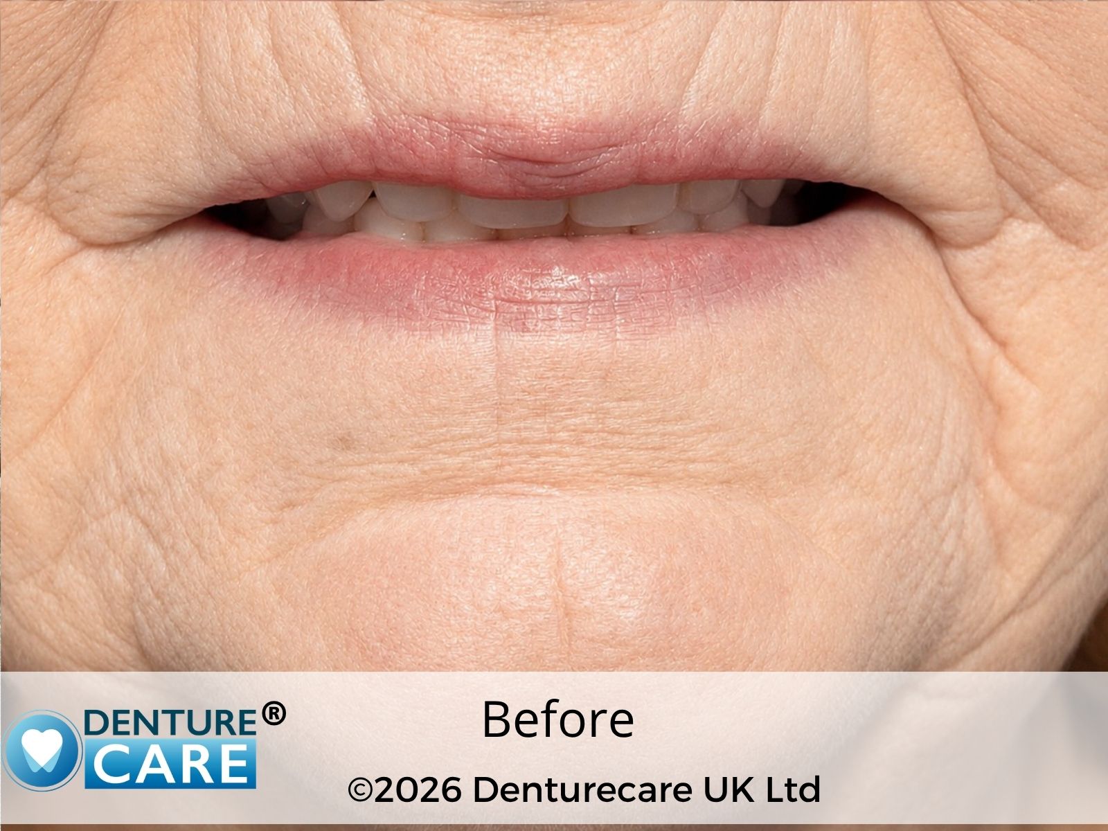 Patient’s smile before new full dentures – Doncaster denture clinic
