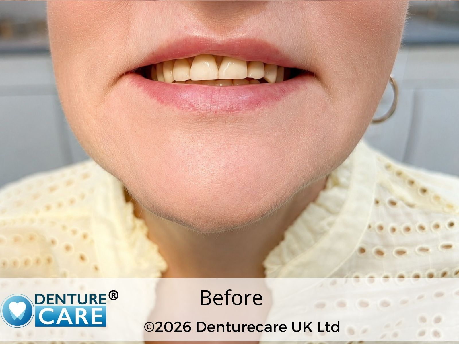 Patient’s smile before new full dentures – Doncaster denture clinic