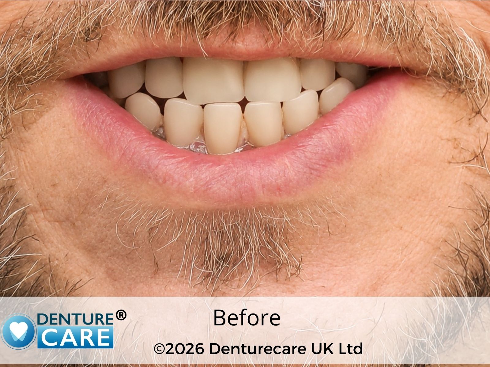 Patient’s smile BEFORE full upper dentures – BARNSLEY Denture clinic